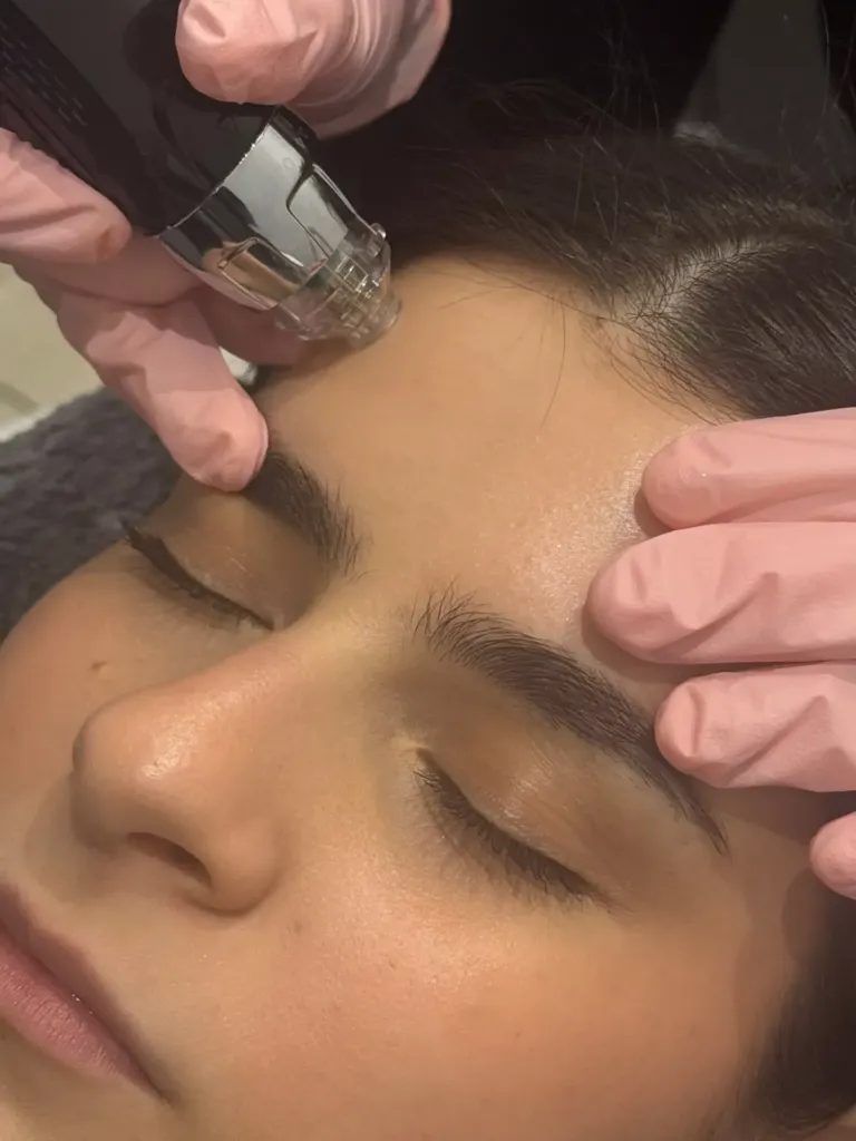 Mujer recibiendo sesión de microneedling